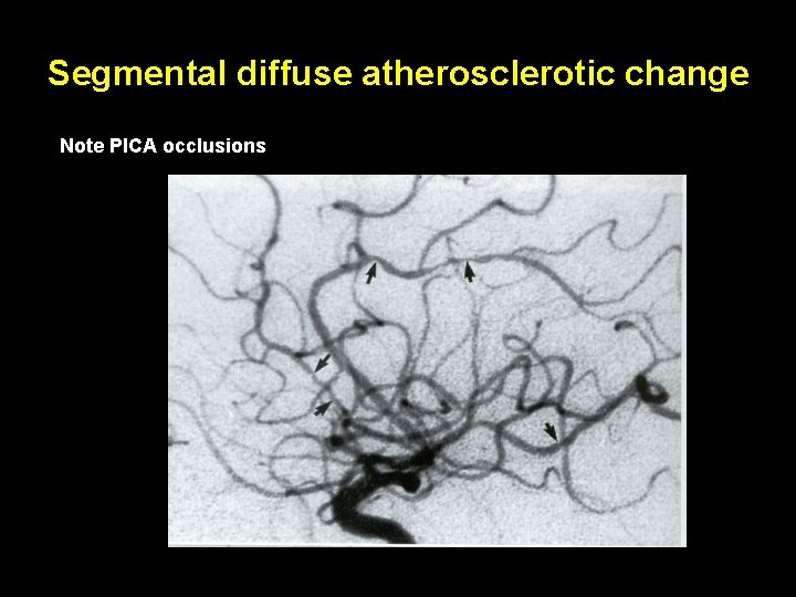 Segmental diffuse atherosclerotic change Note PICA occlusions 