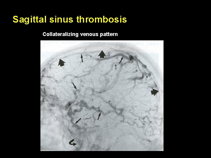 Sagittal sinus thrombosis Collateralizing venous pattern 