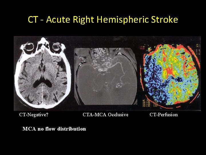 CT - Acute Right Hemispheric Stroke e CT-Negative? CTA-MCA Occlusive MCA no flow distribution
