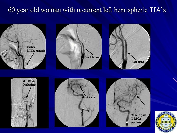 60 year old woman with recurrent left hemispheric TIA’s Critical L ICA stenosis Pre-dilation