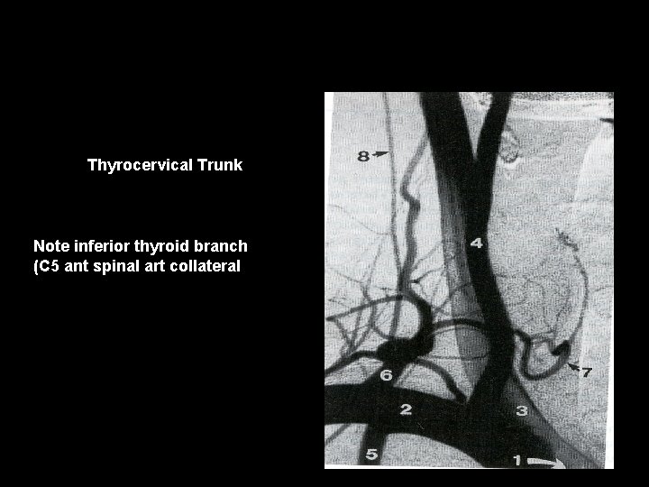 Thyrocervical Trunk Note inferior thyroid branch (C 5 ant spinal art collateral 