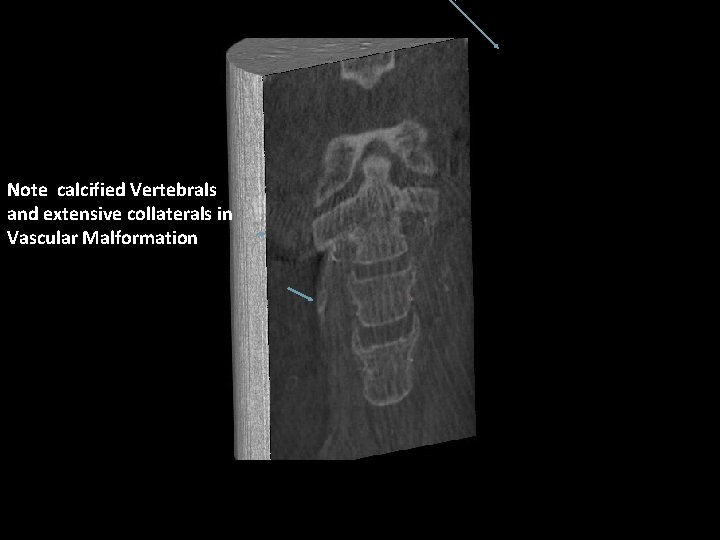 Note calcified Vertebrals and extensive collaterals in Vascular Malformation 