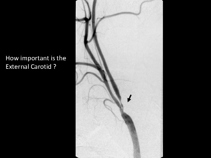 How important is the External Carotid ? 