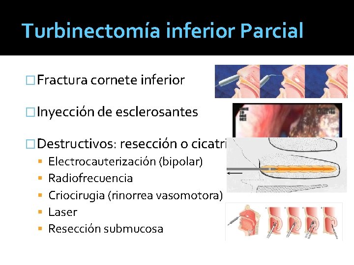 Turbinectomía inferior Parcial �Fractura cornete inferior �Inyección de esclerosantes �Destructivos: resección o cicatrización Electrocauterización