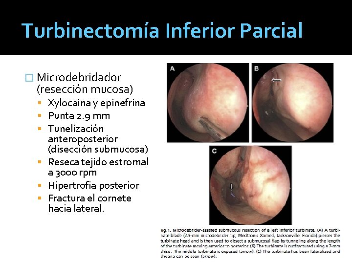 Turbinectomía Inferior Parcial � Microdebridador (resección mucosa) Xylocaina y epinefrina Punta 2. 9 mm