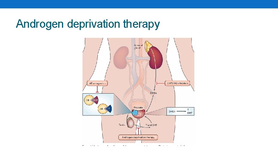 Androgen deprivation therapy 