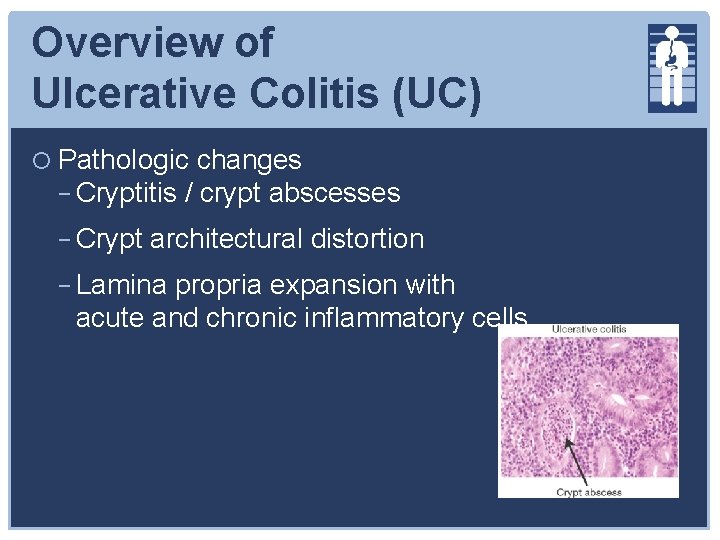 Overview of Ulcerative Colitis (UC) Pathologic changes − Cryptitis / crypt abscesses − Crypt