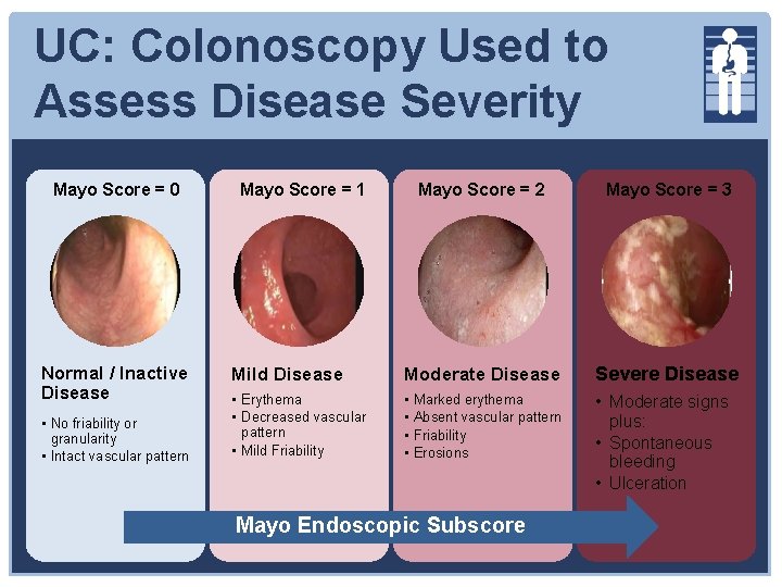 UC: Colonoscopy Used to Assess Disease Severity Mayo Score = 0 Normal / Inactive