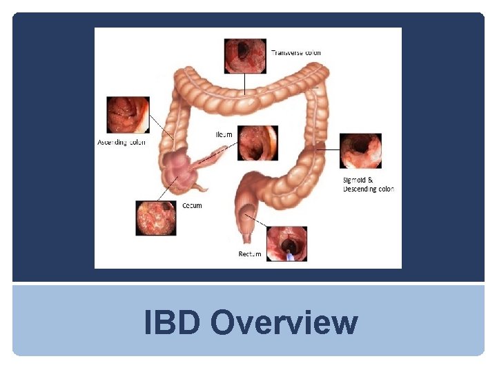 IBD Overview 