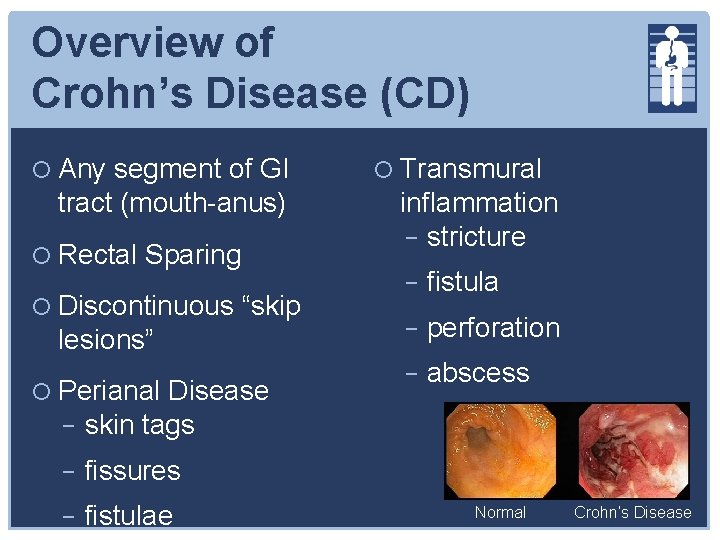 Overview of Crohn’s Disease (CD) Any segment of GI tract (mouth-anus) Rectal Sparing Discontinuous