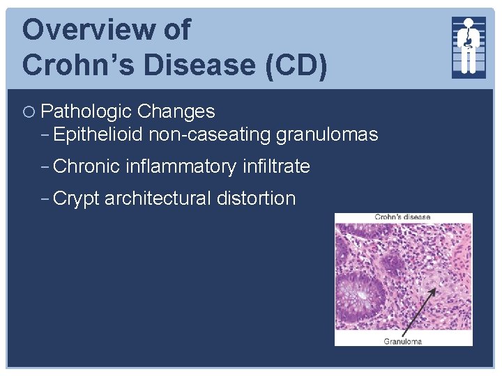Overview of Crohn’s Disease (CD) Pathologic Changes − Epithelioid non-caseating granulomas − Chronic inflammatory