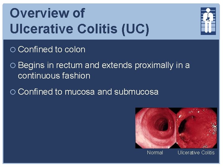 Overview of Ulcerative Colitis (UC) Confined to colon Begins in rectum and extends proximally