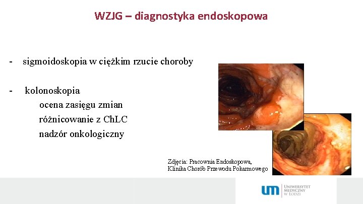 WZJG – diagnostyka endoskopowa Badania endoskopowe: - sigmoidoskopia w ciężkim rzucie choroby - kolonoskopia