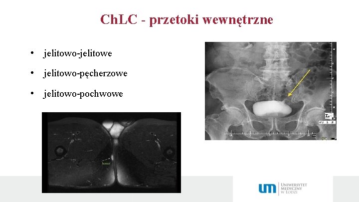 Ch. LC - przetoki wewnętrzne • jelitowo-jelitowe • jelitowo-pęcherzowe • jelitowo-pochwowe 