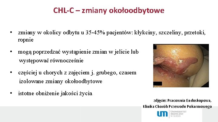 CHL-C – zmiany okołoodbytowe • zmiany w okolicy odbytu u 35 -45% pacjentów: kłykciny,