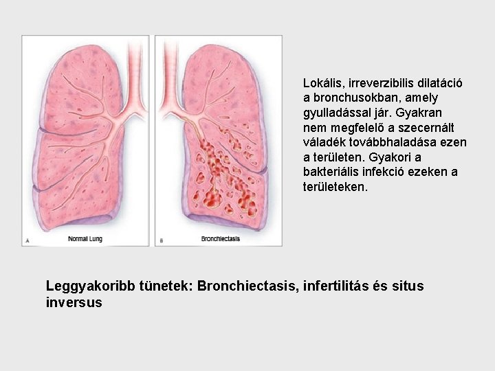 Lokális, irreverzibilis dilatáció a bronchusokban, amely gyulladással jár. Gyakran nem megfelelő a szecernált váladék