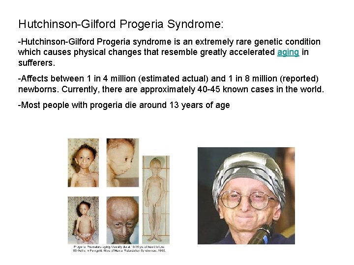 Hutchinson-Gilford Progeria Syndrome: -Hutchinson-Gilford Progeria syndrome is an extremely rare genetic condition which causes