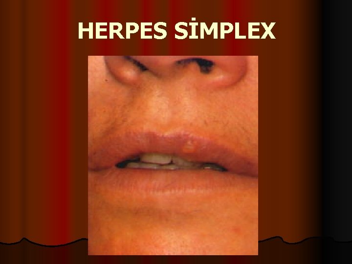 HERPES SİMPLEX 