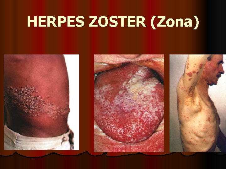 HERPES ZOSTER (Zona) 