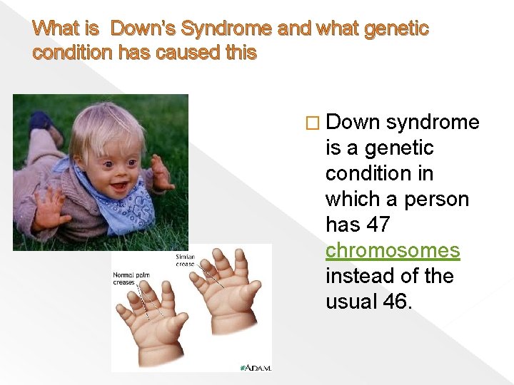 What is Down’s Syndrome and what genetic condition has caused this � Down syndrome