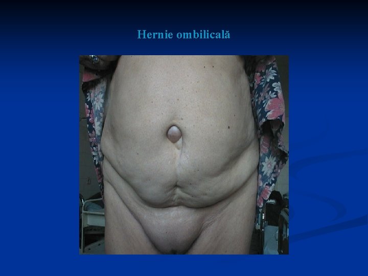 Hernie ombilicală 