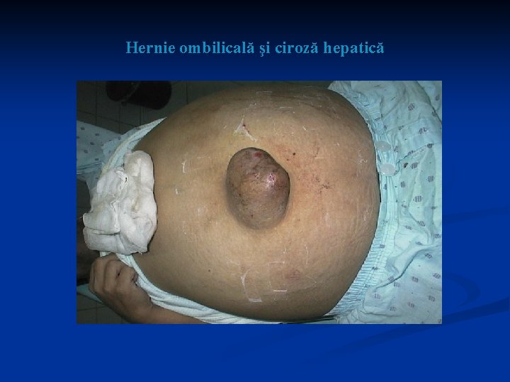 Hernie ombilicală şi ciroză hepatică 