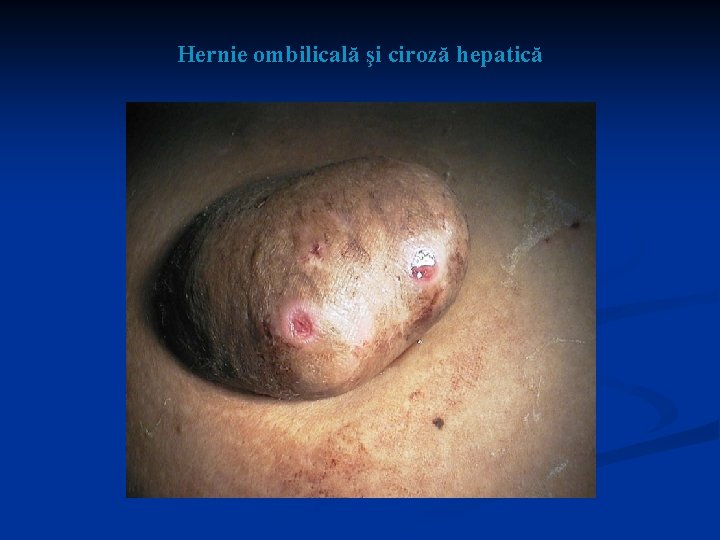 Hernie ombilicală şi ciroză hepatică 