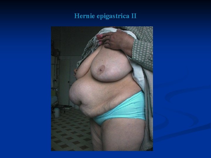 Hernie epigastrica II 