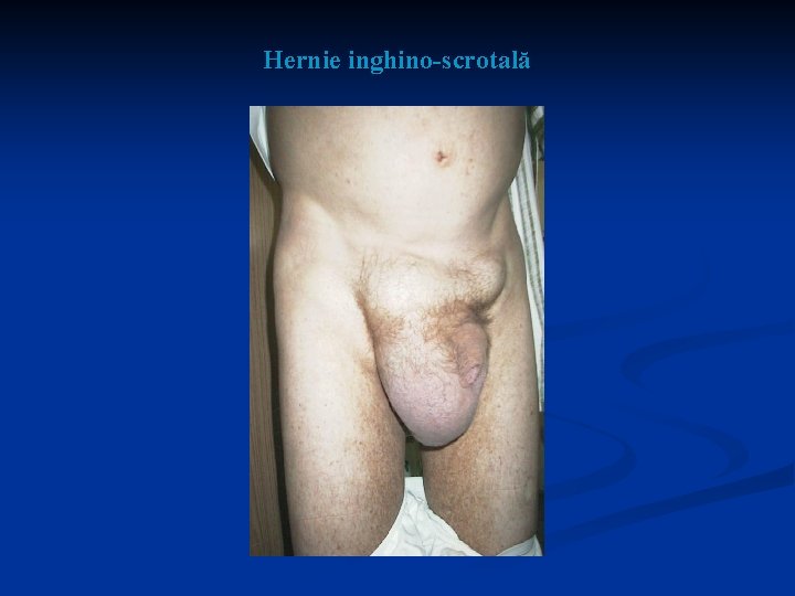 Hernie inghino-scrotală 