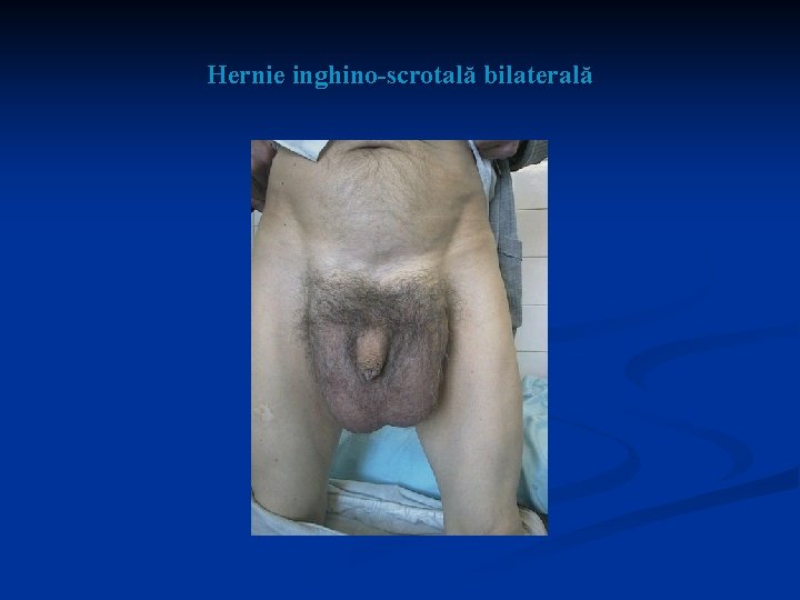 Hernie inghino-scrotală bilaterală 