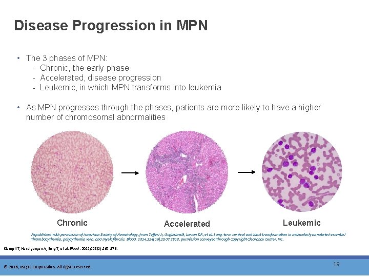 Disease Progression in MPN • The 3 phases of MPN: - Chronic, the early