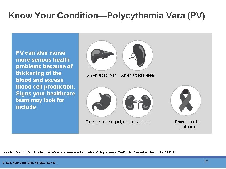 Know Your Condition—Polycythemia Vera (PV) PV can also cause more serious health problems because