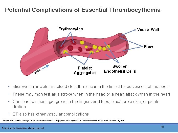 Potential Complications of Essential Thrombocythemia Erythrocytes Vessel Wall Flow Fl ow Platelet Aggregates Swollen