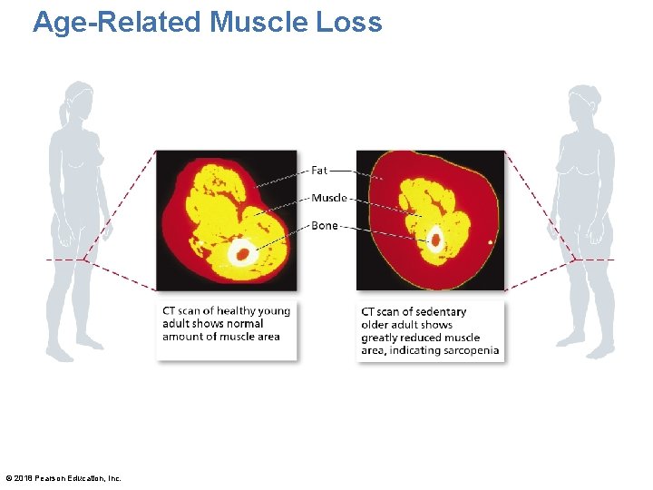 Age-Related Muscle Loss © 2018 Pearson Education, Inc. 