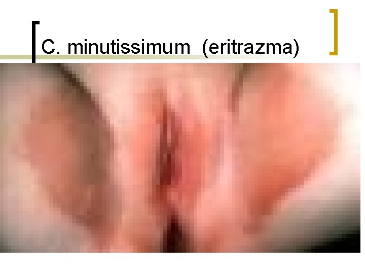 C. minutissimum (eritrazma) 
