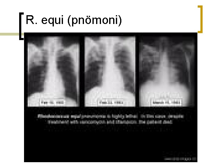 R. equi (pnömoni) 