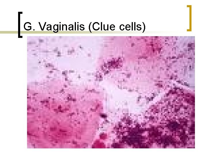 G. Vaginalis (Clue cells) 