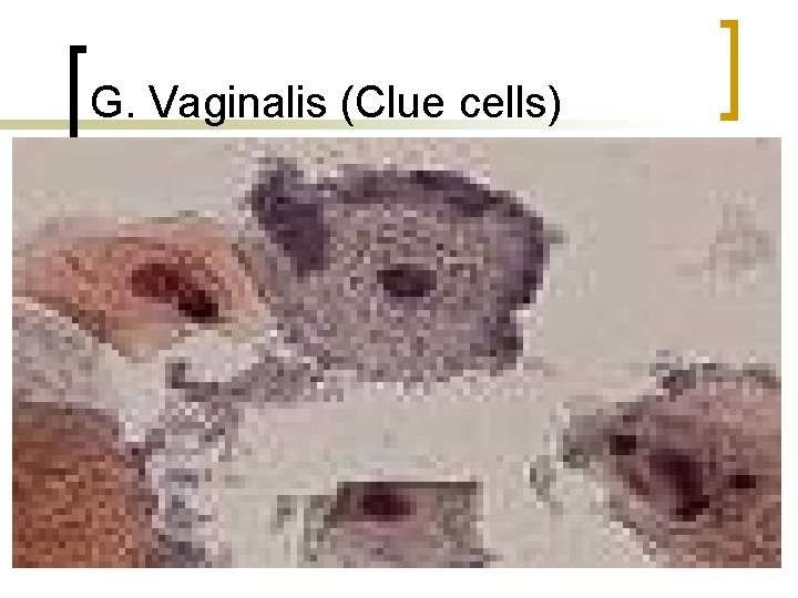 G. Vaginalis (Clue cells) 