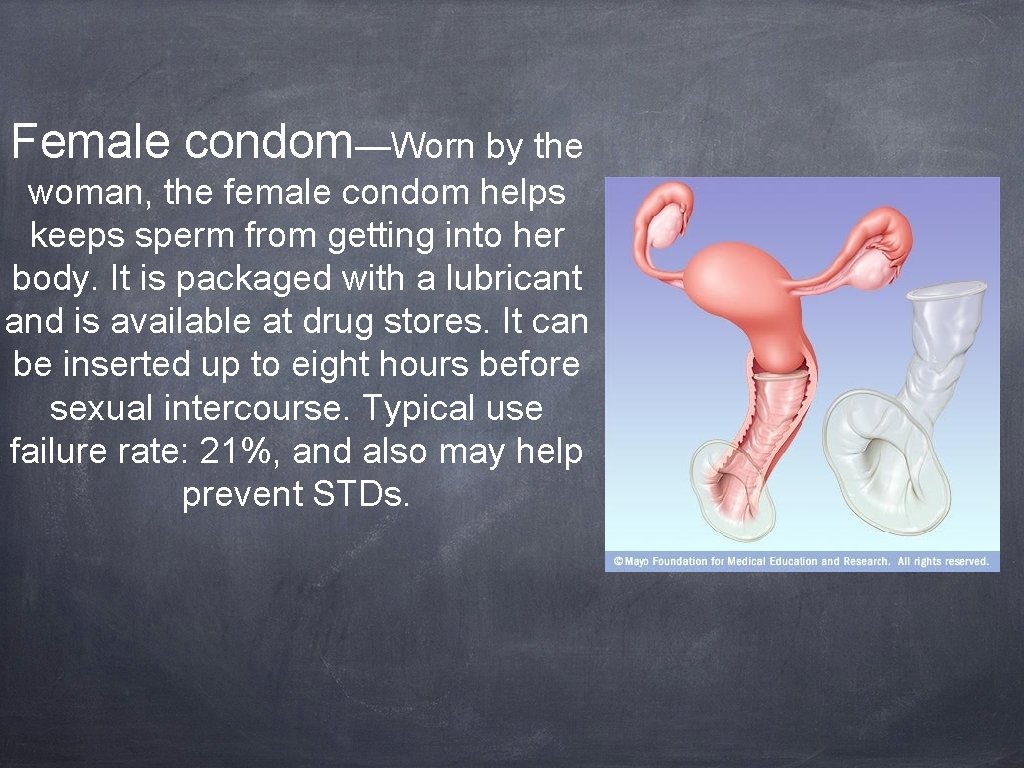 Female condom—Worn by the woman, the female condom helps keeps sperm from getting into
