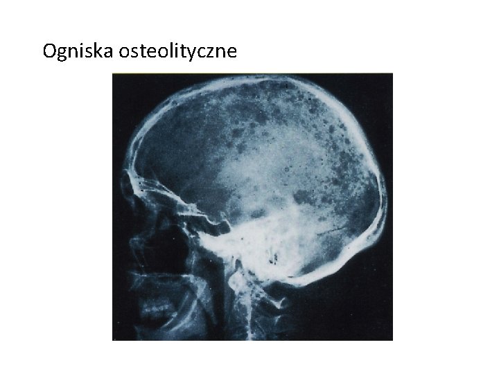 Ogniska osteolityczne 