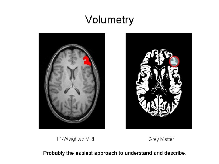 Volumetry T 1 -Weighted MRI Grey Matter Probably the easiest approach to understand describe.