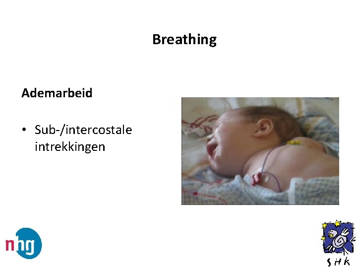 Breathing Ademarbeid • Sub-/intercostale intrekkingen 