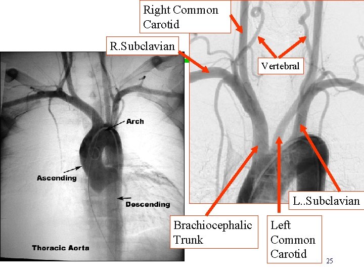 Right Common Carotid R. Subclavian Vertebral L. . Subclavian Brachiocephalic Trunk Left Common Carotid