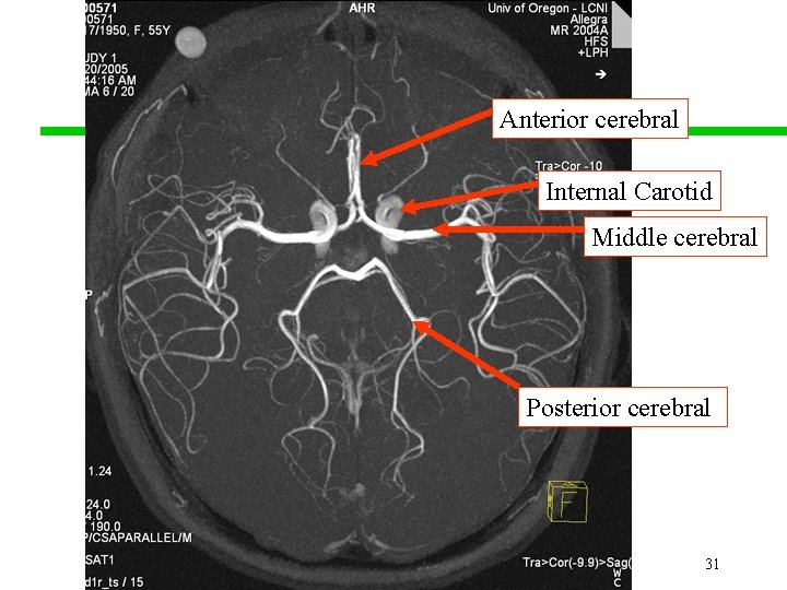 Anterior cerebral Internal Carotid Middle cerebral Posterior cerebral 31 