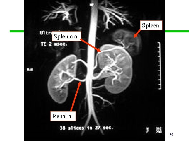 Spleen Splenic a. Renal a. 35 