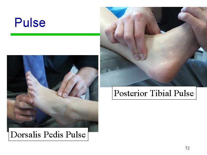 Pulse Posterior Tibial Pulse Dorsalis Pedis Pulse 72 