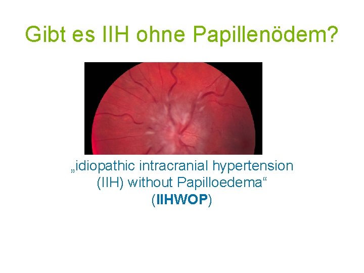 Gibt es IIH ohne Papillenödem? „idiopathic intracranial hypertension (IIH) without Papilloedema“ (IIHWOP) 