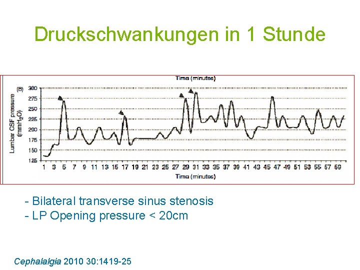 Druckschwankungen in 1 Stunde - Bilateral transverse sinus stenosis - LP Opening pressure <