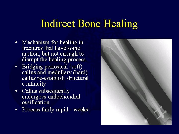 Indirect Bone Healing • Mechanism for healing in fractures that have some motion, but