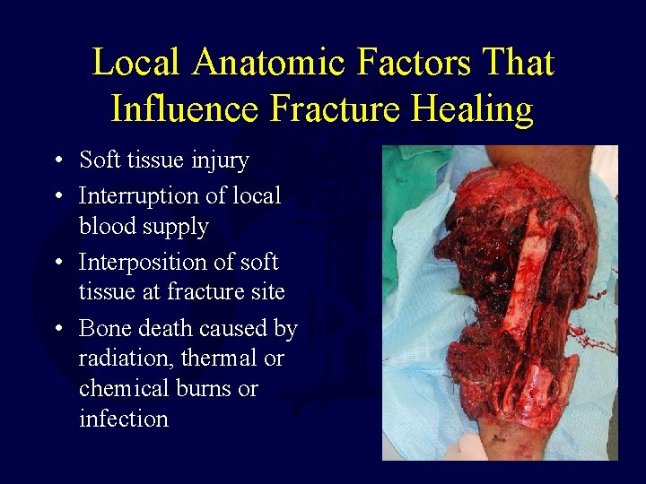 Local Anatomic Factors That Influence Fracture Healing • Soft tissue injury • Interruption of